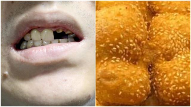man-broke-teeth-bun-bite-stone-implants-singapore-viral-2.jpg