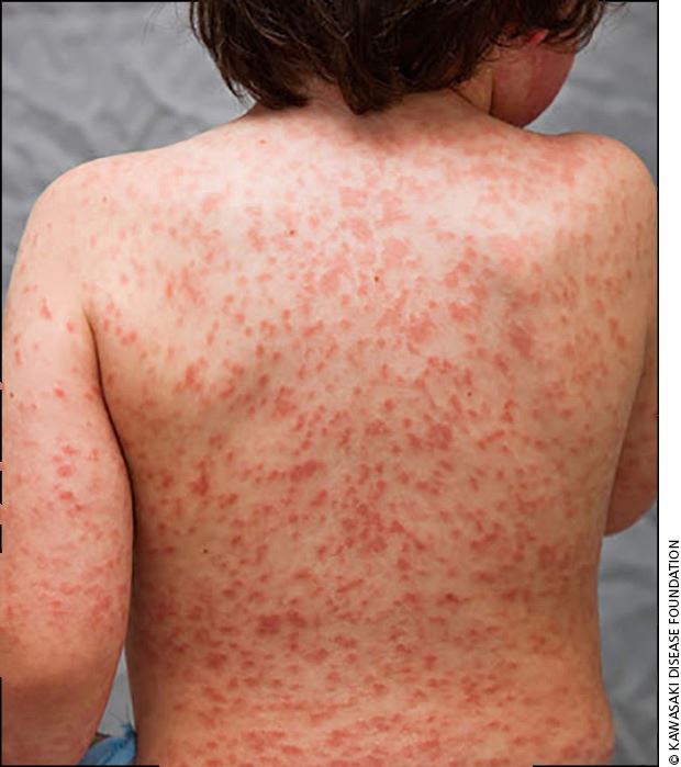 75 peratus pesakit adalah kanak-kanak, kenali apa itu penyakit kawasaki