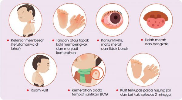 75 peratus pesakit adalah kanak-kanak, kenali apa itu penyakit kawasaki