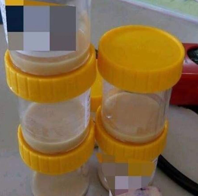 akibat merokok, paru-paru lelaki ini penuh cecair nanah!