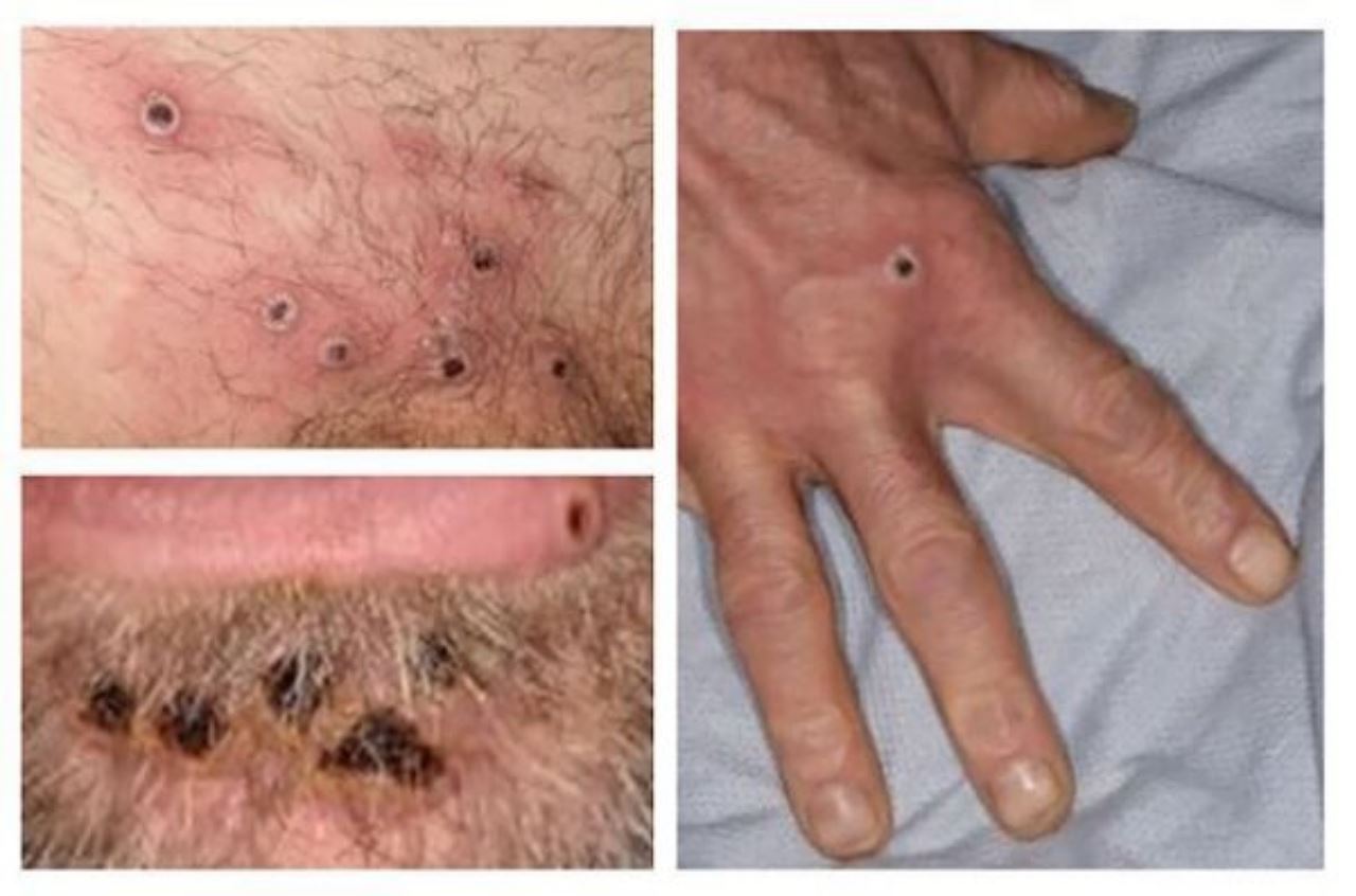 elak stigma, who beri nama baru kepada cacar monyet