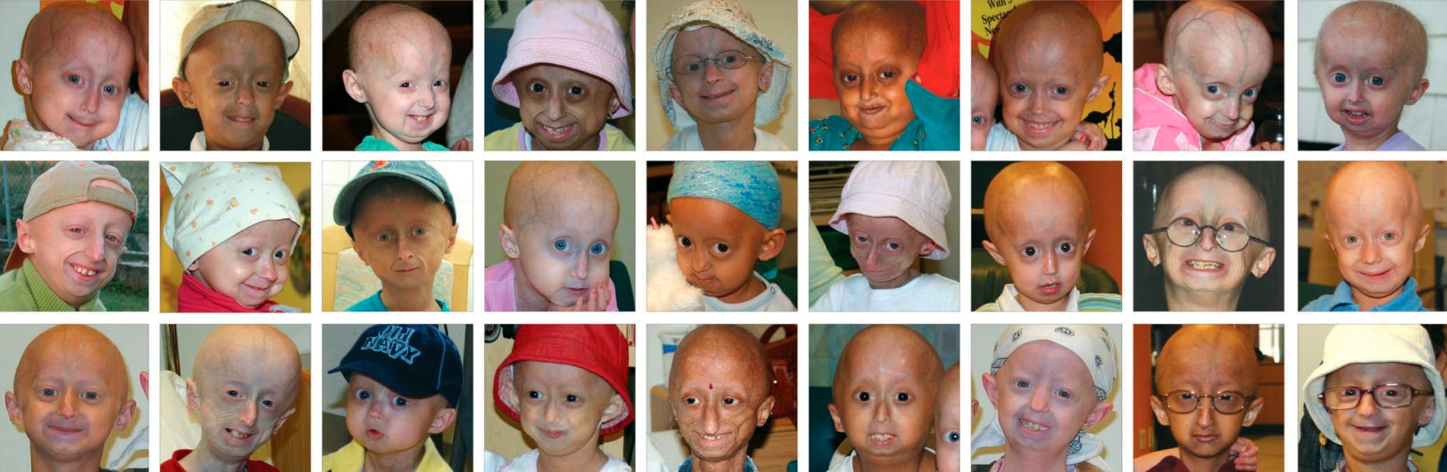 ibu muda terkejut lepas lahirkan bayi berwajah tua