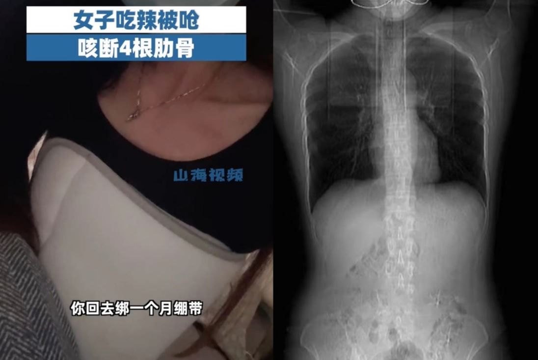 woman in china broke four ribs after a coughing fit caused by eating spicy food