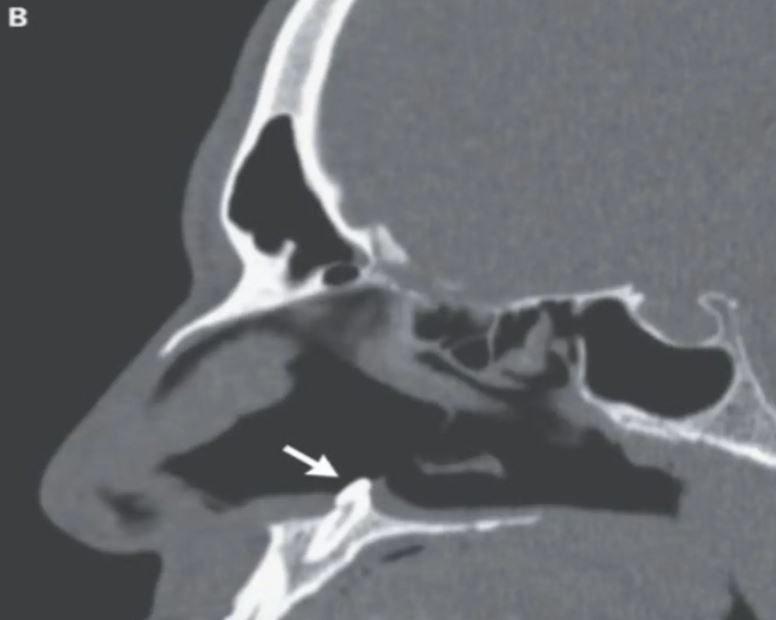 gigi tumbuh dalam rongga hidung ganggu lelaki ini bernafas