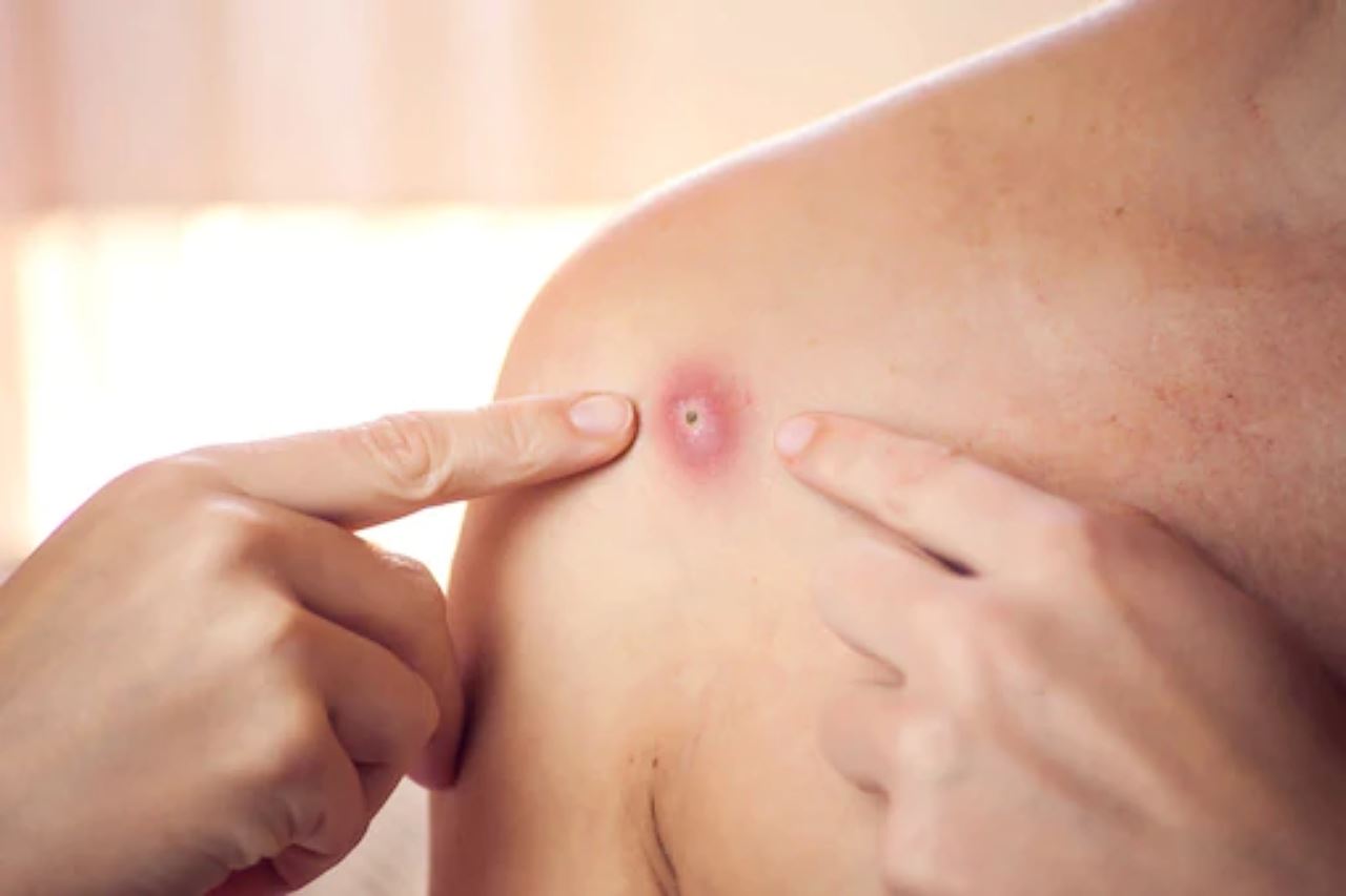 kes cacar monyet telah meningkat tiga kali ganda di eropah