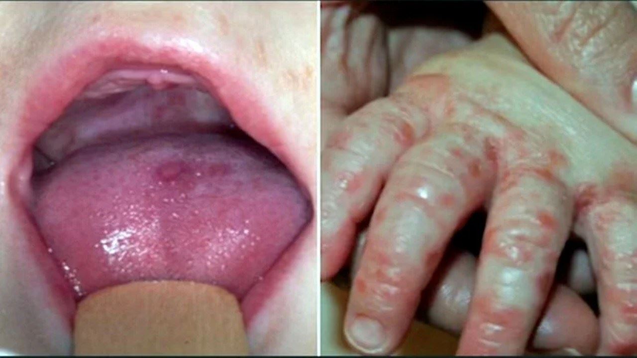 kes hfmd meningkat 27 kali ganda, selangor paling tinggi