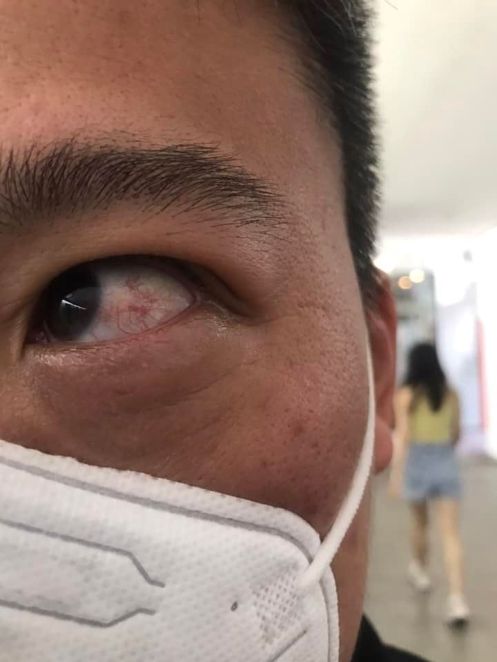 man in taiwan burns eyes and legs after leaving uv lamp on for three hours!