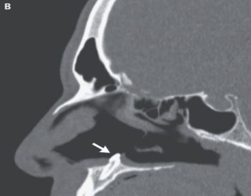 man had trouble breathing, doctors found teeth growing in his nose
