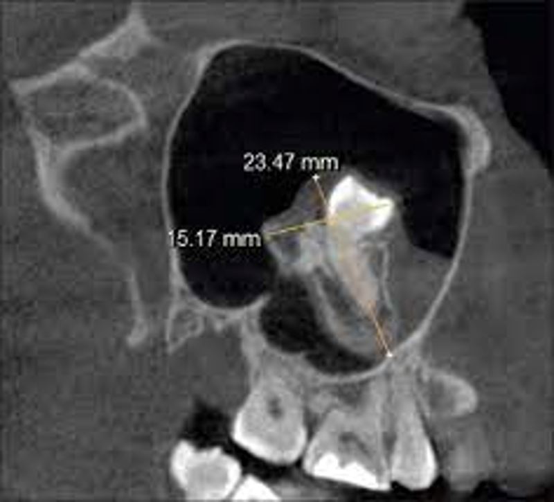 man had trouble breathing, doctors found teeth growing in his nose