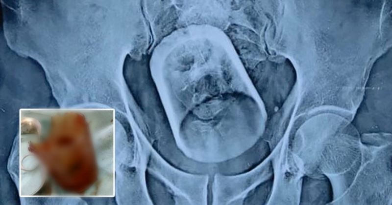 man in india with glass in stomach claims he swallowed it while drinking tea