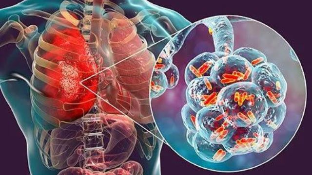 wabak legionnaires dikesan di amerika syarikat, sebabkan dua maut
