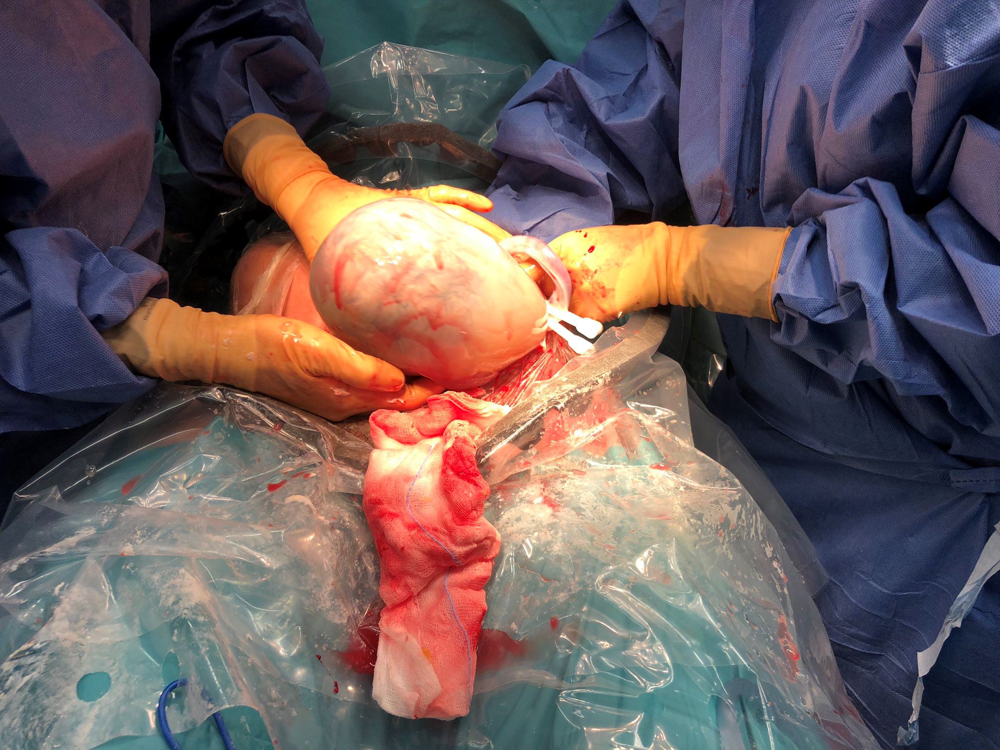 kelahiran unik bayi perempuan ini hanya jadi satu dalam 80,000 