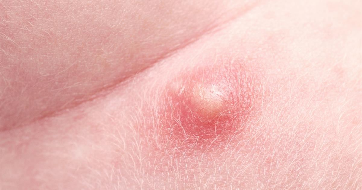 kerap mencukur, berat badan berlebihan antara punca jadi bisul, ayuh semak punca lain disini