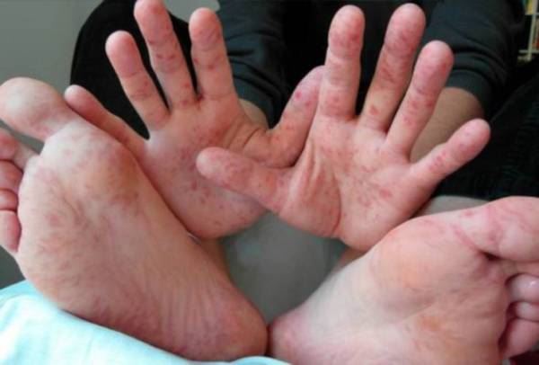 penyakit hfmd makin meningkat, hati-hati guna tandas awam