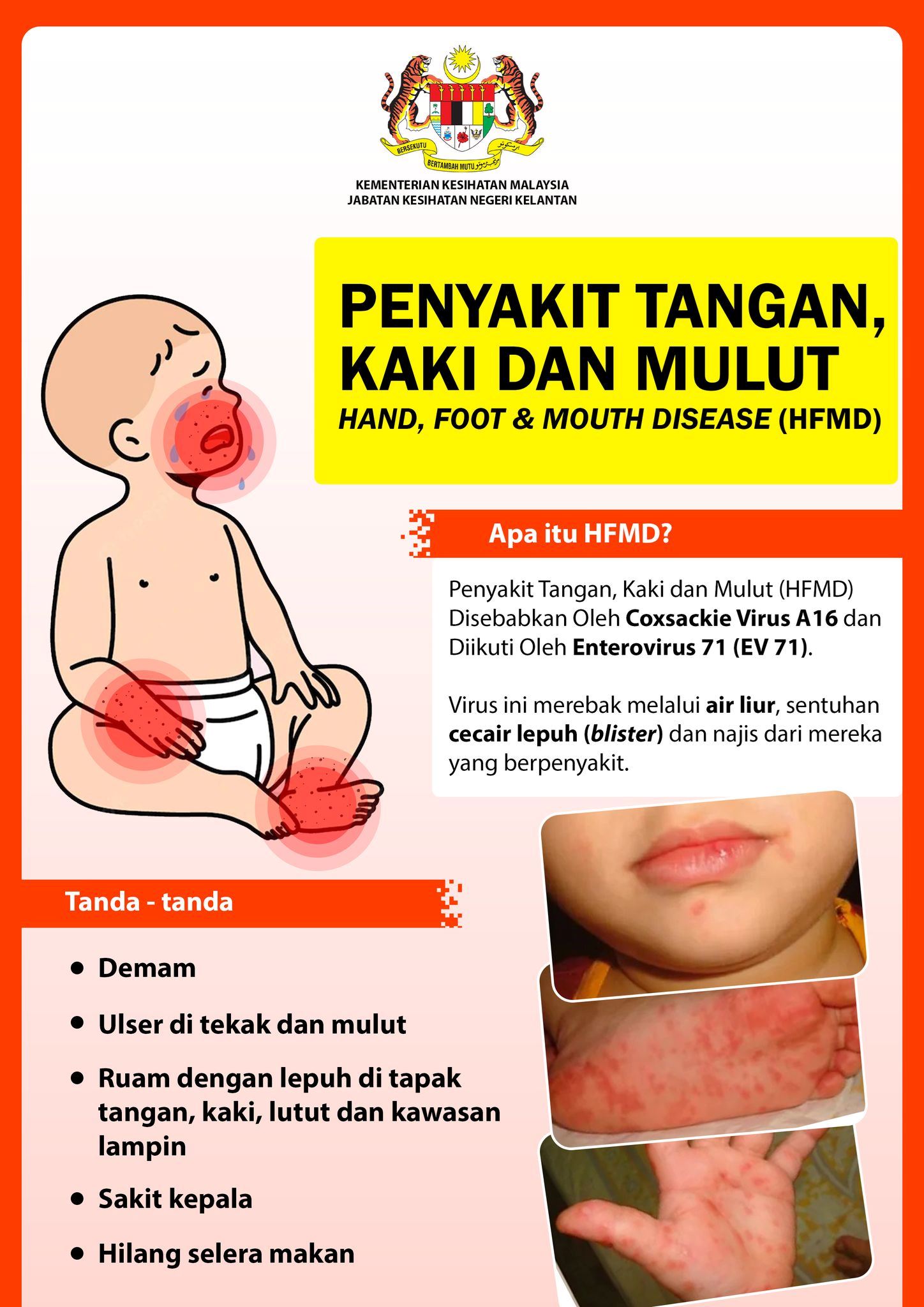 penyakit hfmd makin meningkat, hati-hati guna tandas awam