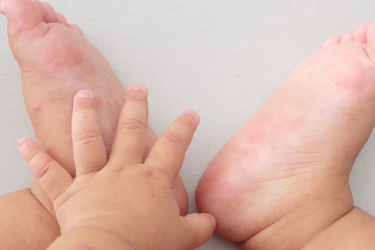 penyakit kaki, tangan dan mulut meningkat 15 kali ganda di malaysia