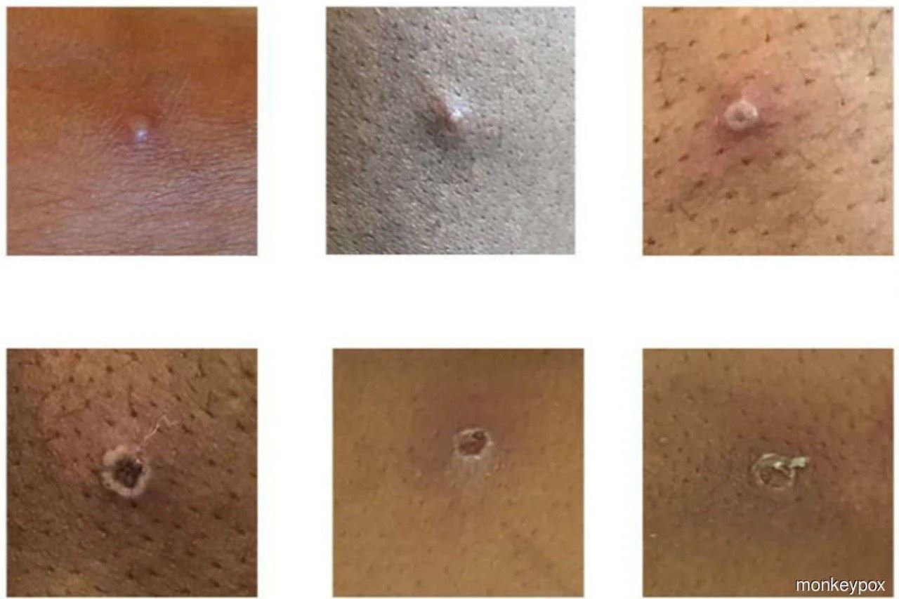 who jangka lebih banyak kes cacar monyet dikesan seluruh dunia