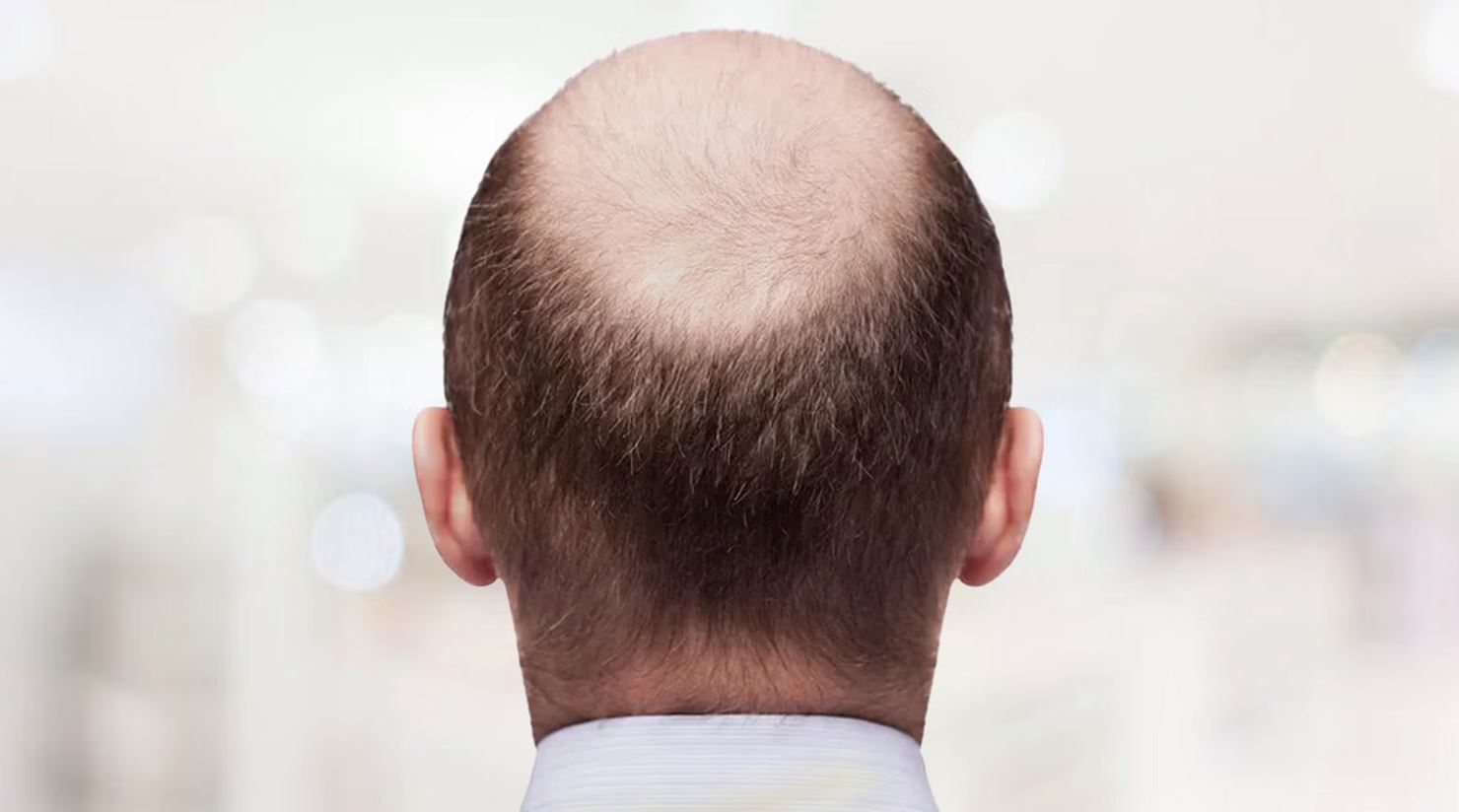 calling your colleague bald is now considered sexual harassment in the uk
