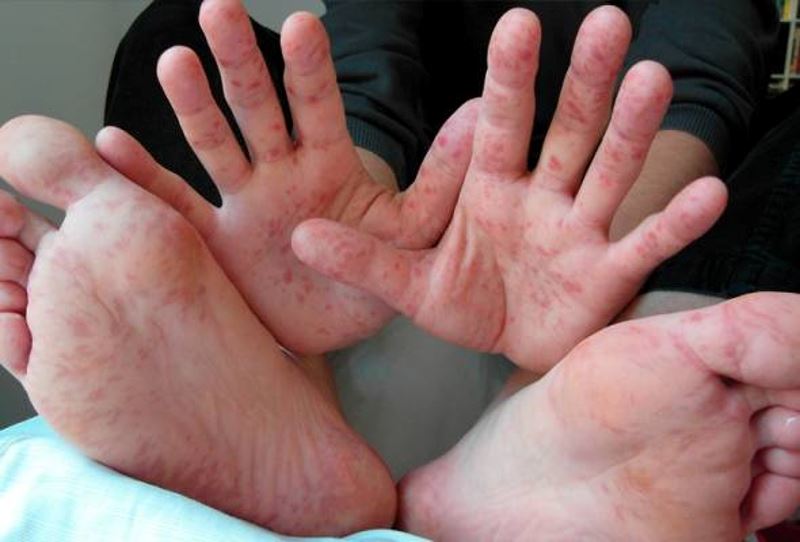 hfmd cases in malaysia have increased 20 times since the beginning of the year