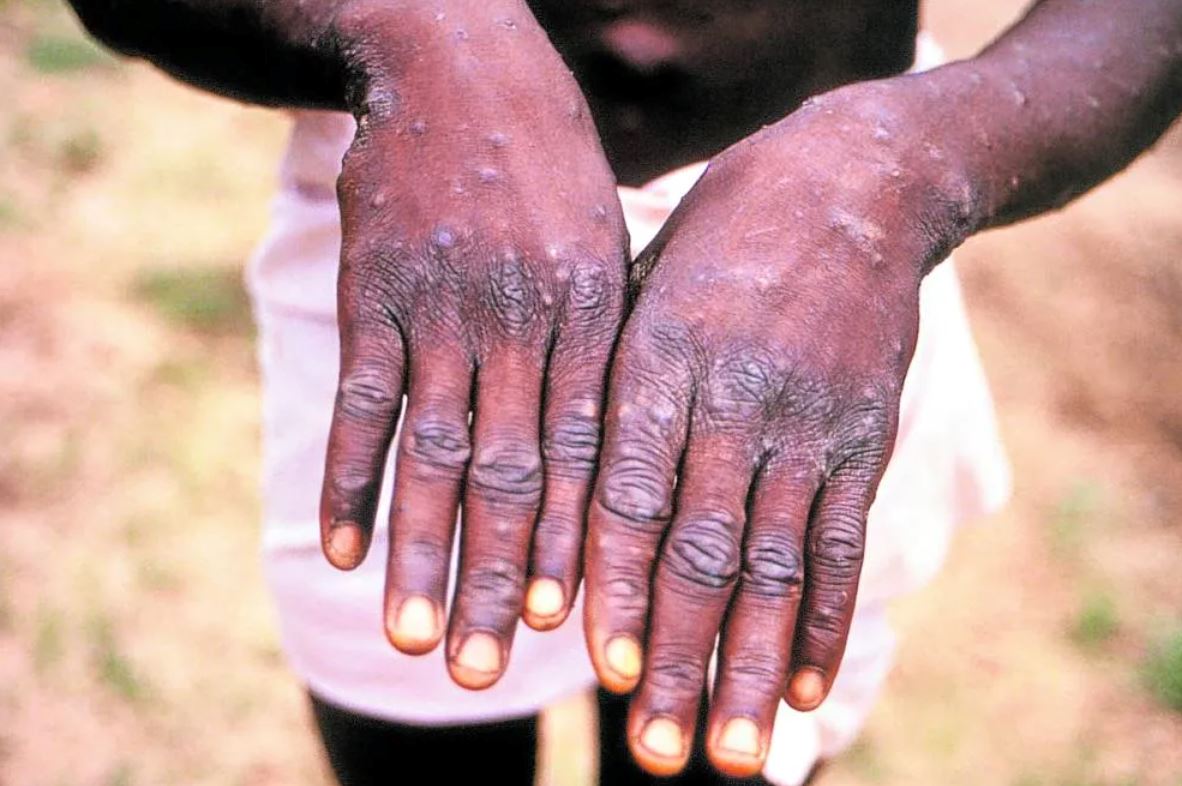it’s unlikely that monkeypox will result in a pandemic, says the who