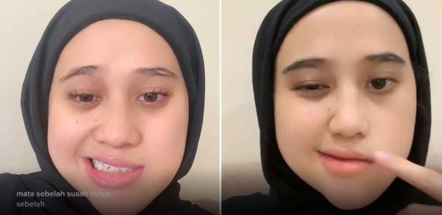 akibat tidur hadap kipas kuat, wajah gadis ini senget sebelah