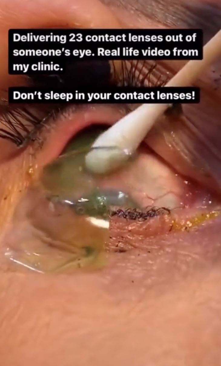 lupa dah pakai, doktor keluarkan 23 kanta sentuh dalam mata pesakit ini