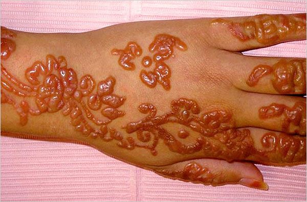 betul ke pakai henna buat kulit berparut kekal?