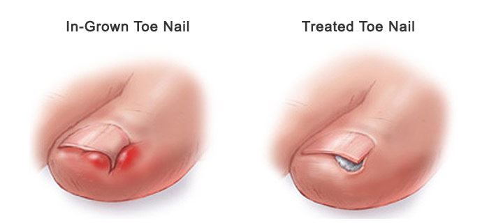 pembedahan kecil rawat cengkam kuku, jika dibiar lebih parah!