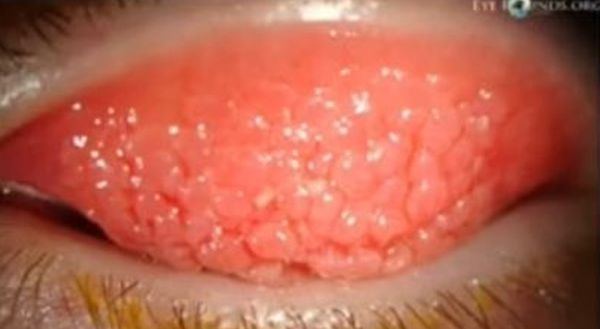 ibu terkejut lihat mata anaknya yang ketagih gajet