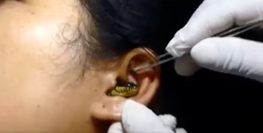 ular tersekat dalam lubang telinga wanita ini undang tanda tanya