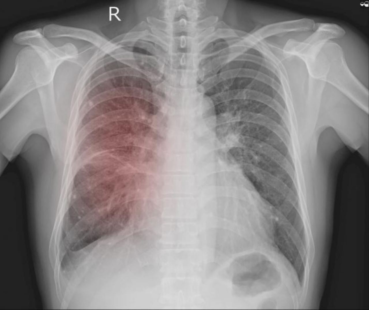 sudah tiga individu maut akibat radang paru-paru misteri di argentina