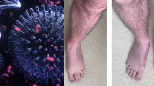 long-covid-kaki-jadi-ungu-640.png