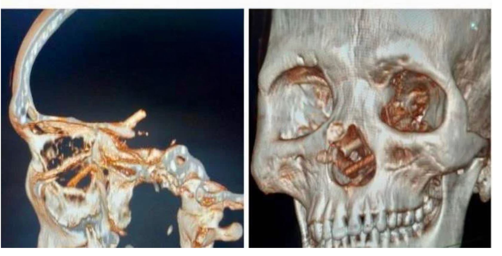 lebih 5 bulan asyik sakit kepala rupanya ada chopstik dalam tengkorak