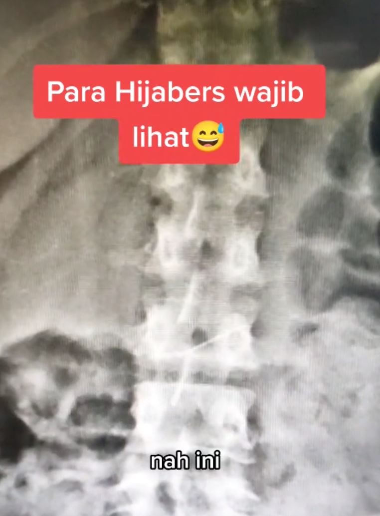 panik! wanita tertelan jarum peniti masa nak pakai tudung [video]