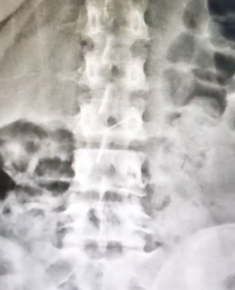 panik! wanita tertelan jarum peniti masa nak pakai tudung [video]