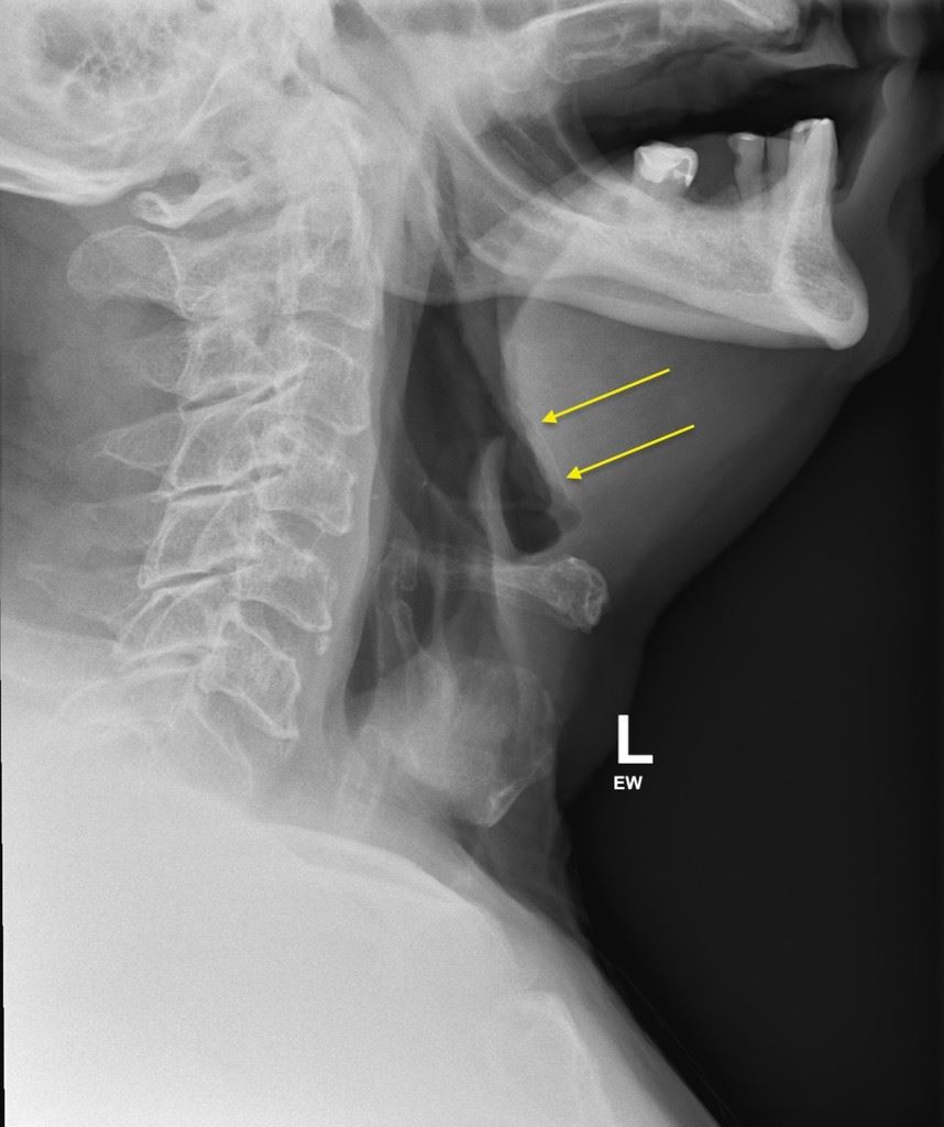 pelik, wanita tercekik tulang tapi doktor suruh minum air gas untuk larutkan?