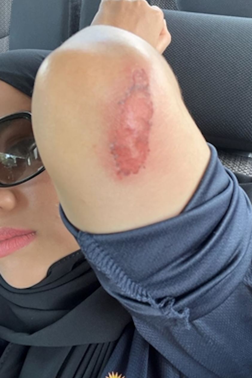 demi tuntutan kerja, hawa rizwana tak kisah badan calar-balar