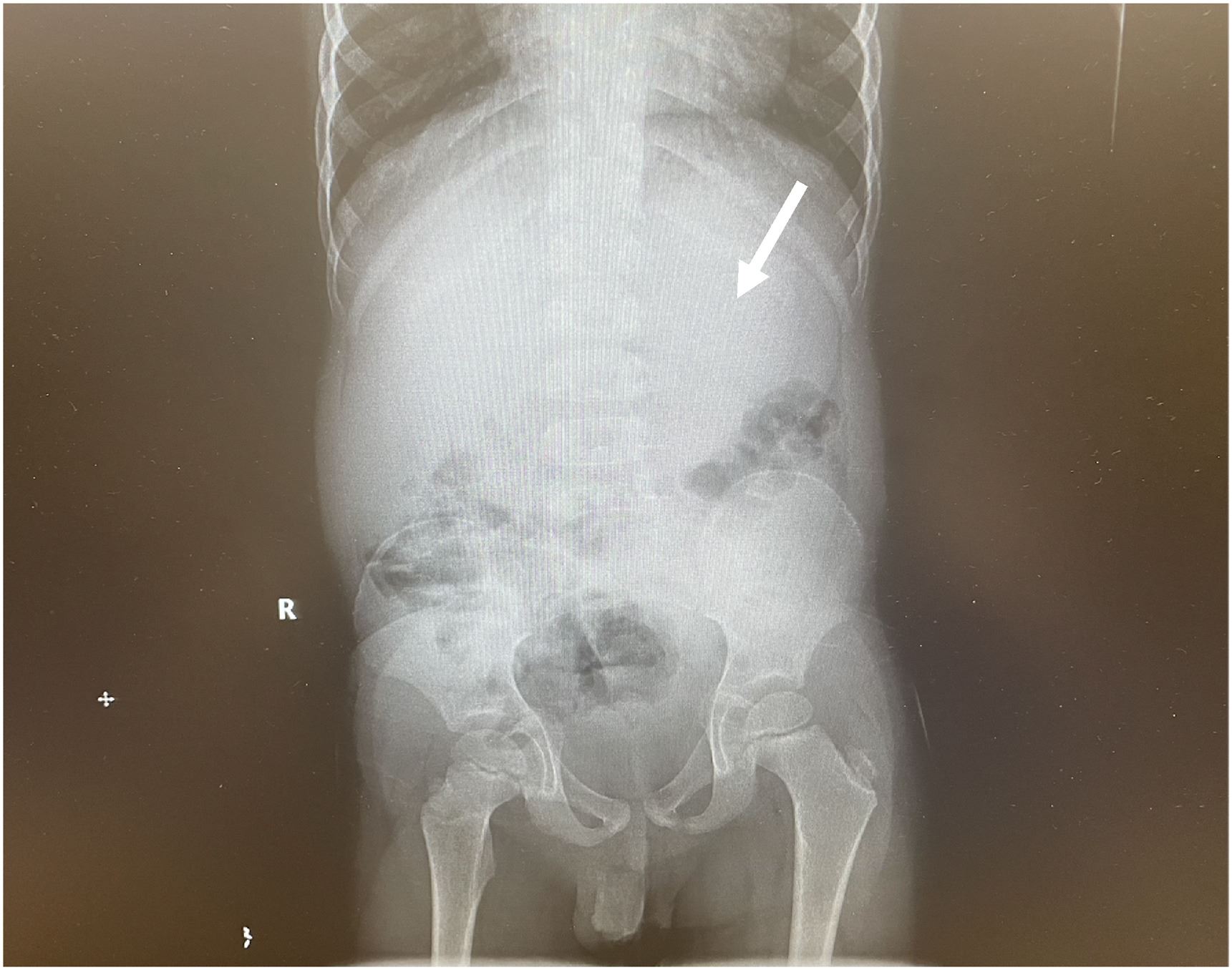 nyaris maut, kanak-kanak usia lima tahun telan hampir 40 chewing gum