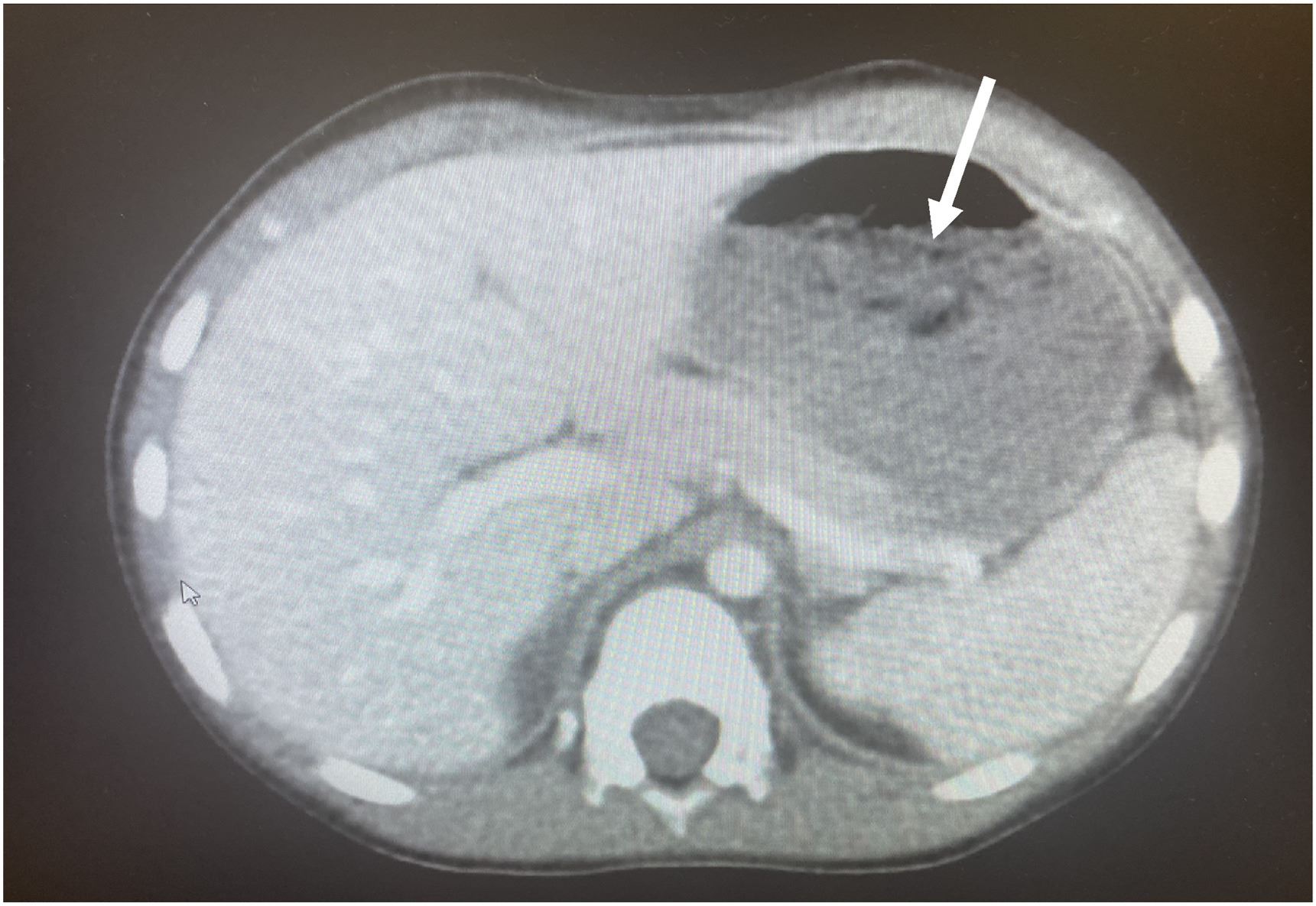 nyaris maut, kanak-kanak usia lima tahun telan hampir 40 chewing gum