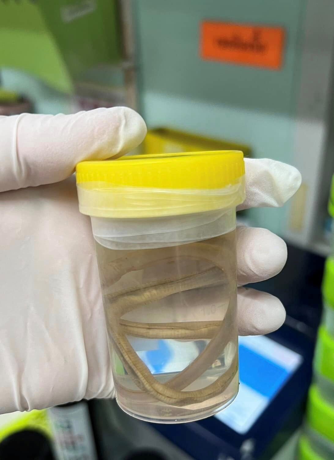 wanita sarat hamil terkejut lepas muntah keluar cacing 15 sentimeter