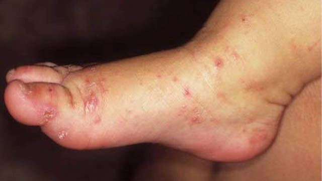 5 penyakit kulit ini terjadi ketika musim hujan