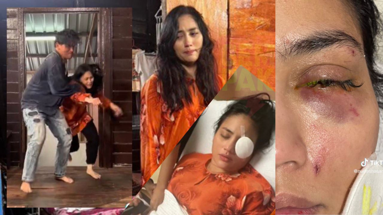 ngeri! tulang mata patah, bebola mata fasha sandha berdarah masa sedang berlakon