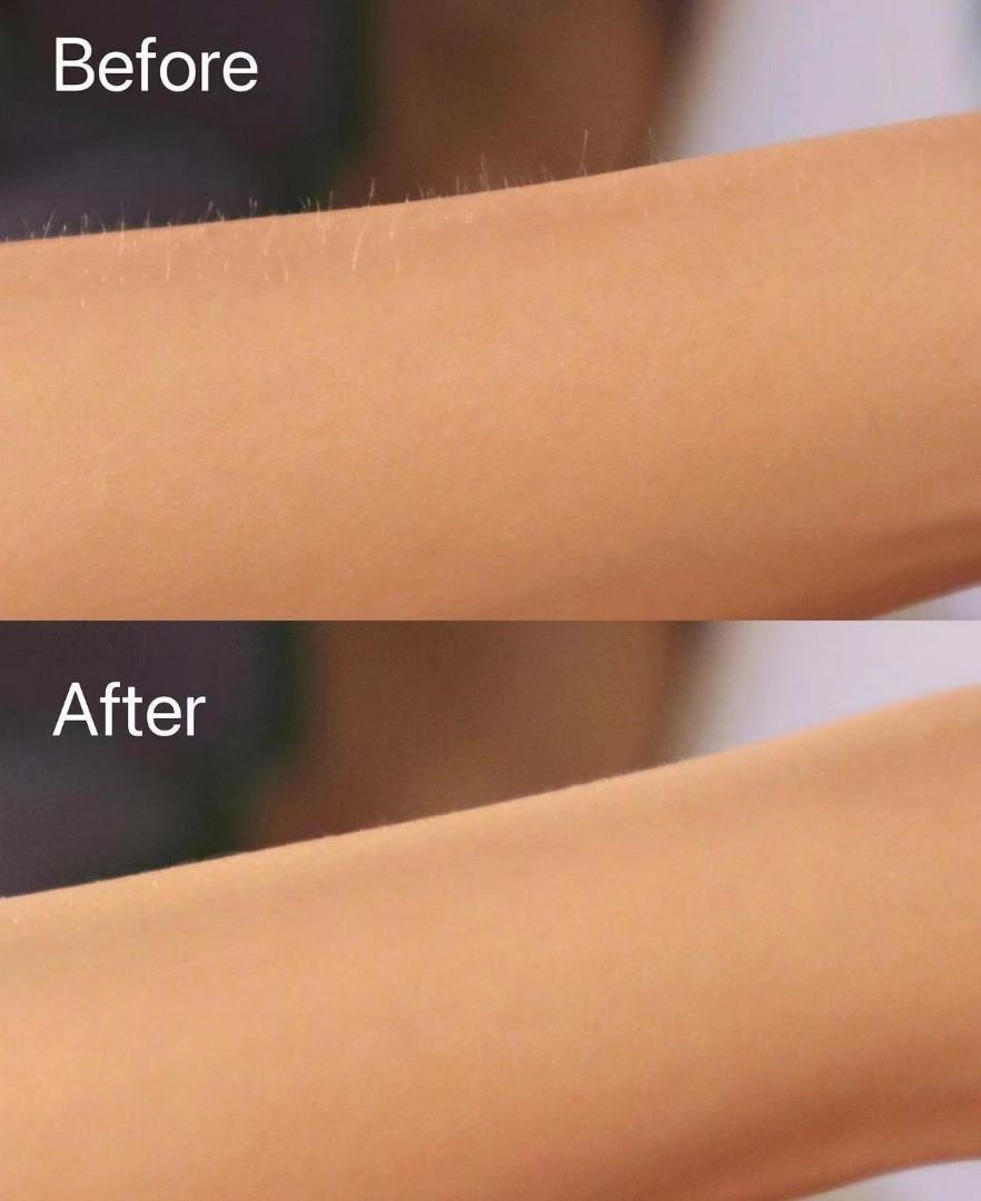 before after ULike IPL device