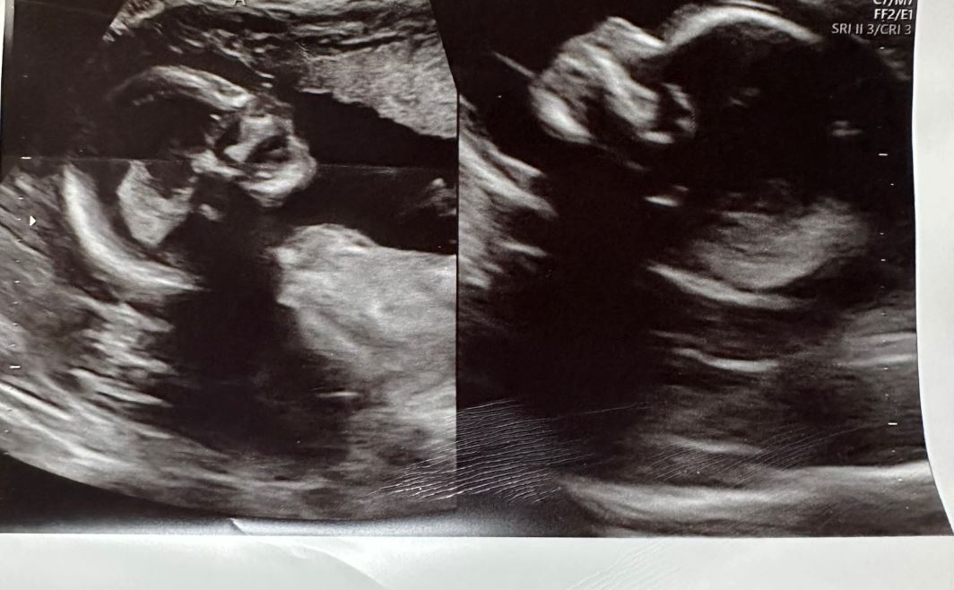 wanita dua rahim kini hamil anak kembar di kedua-duanya