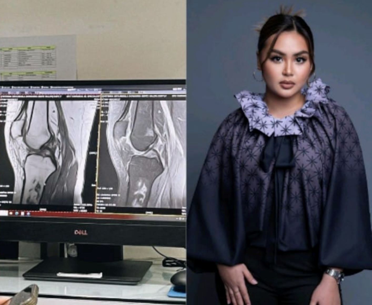 gara-gara lutut ‘meletup’, bella dowanna kini terpaksa bertongkat