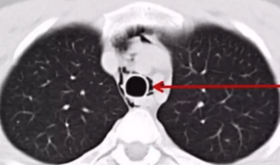 paru-paru lelaki ini runtuh lepas jerit kuat sangat di konsert 