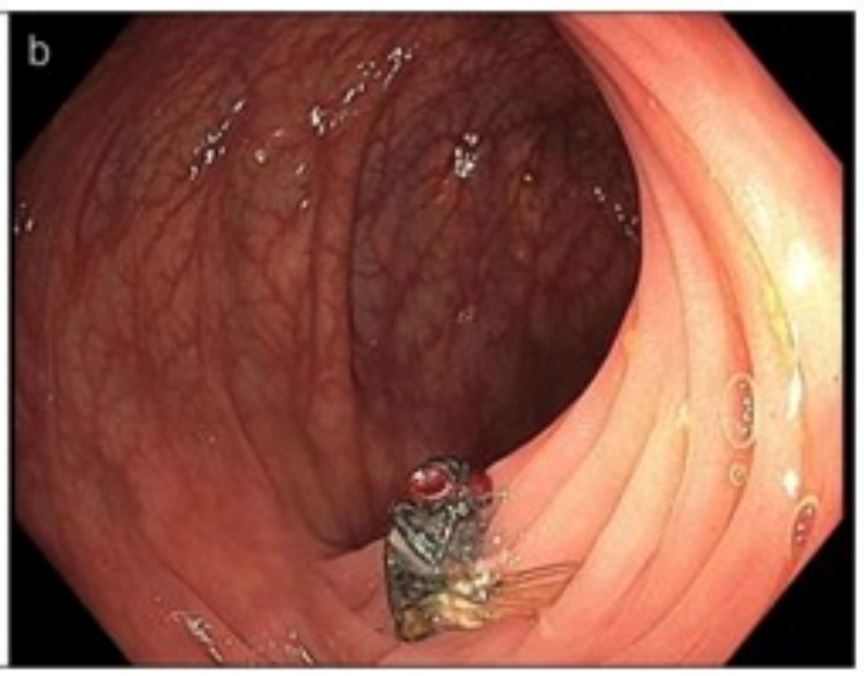 doktor terkejut jumpa lalat hidup dalam usus pesakit umur 63 tahun
