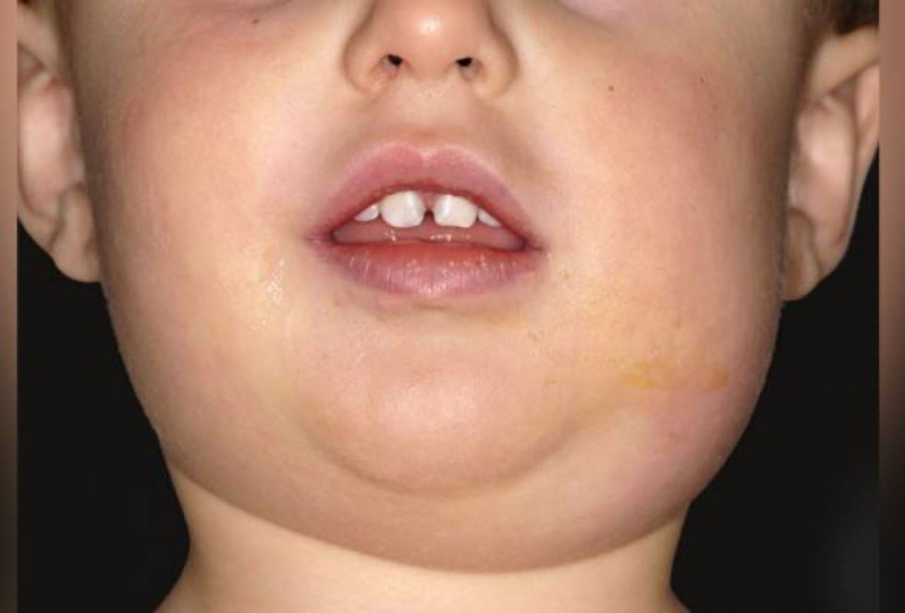 virus beguk mudah jangkit pada kanak-kanak, “boleh cegah dengan vaksinasi” – kkm