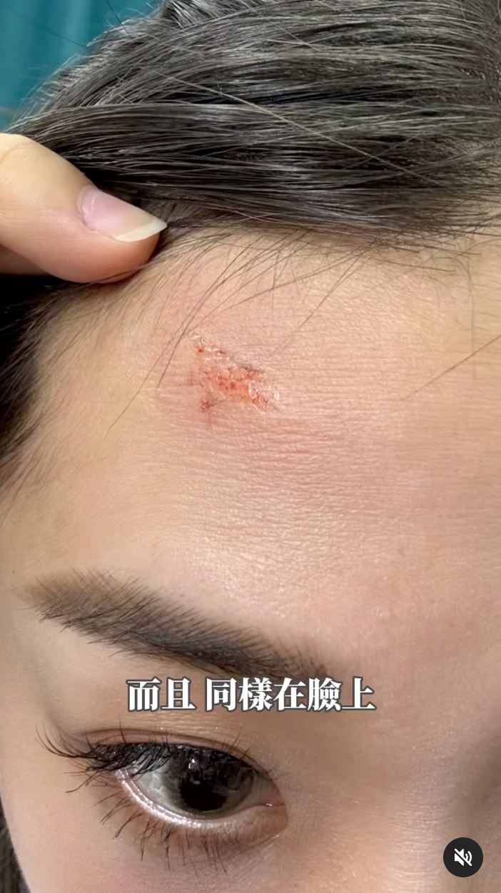 艾薇彩排不慎额头受伤❗表演高难度芭蕾舞🩰