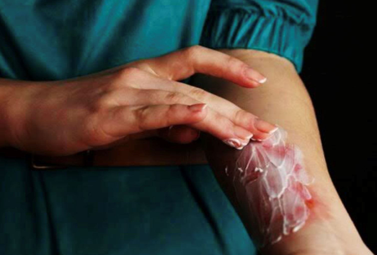 post-putra heights incident: doctor advises against toothpaste for burn treatment